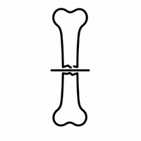 Fracture Fixation Surgery