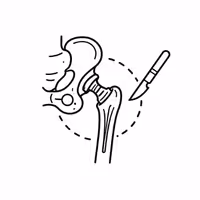 Hip Replacement Surgery